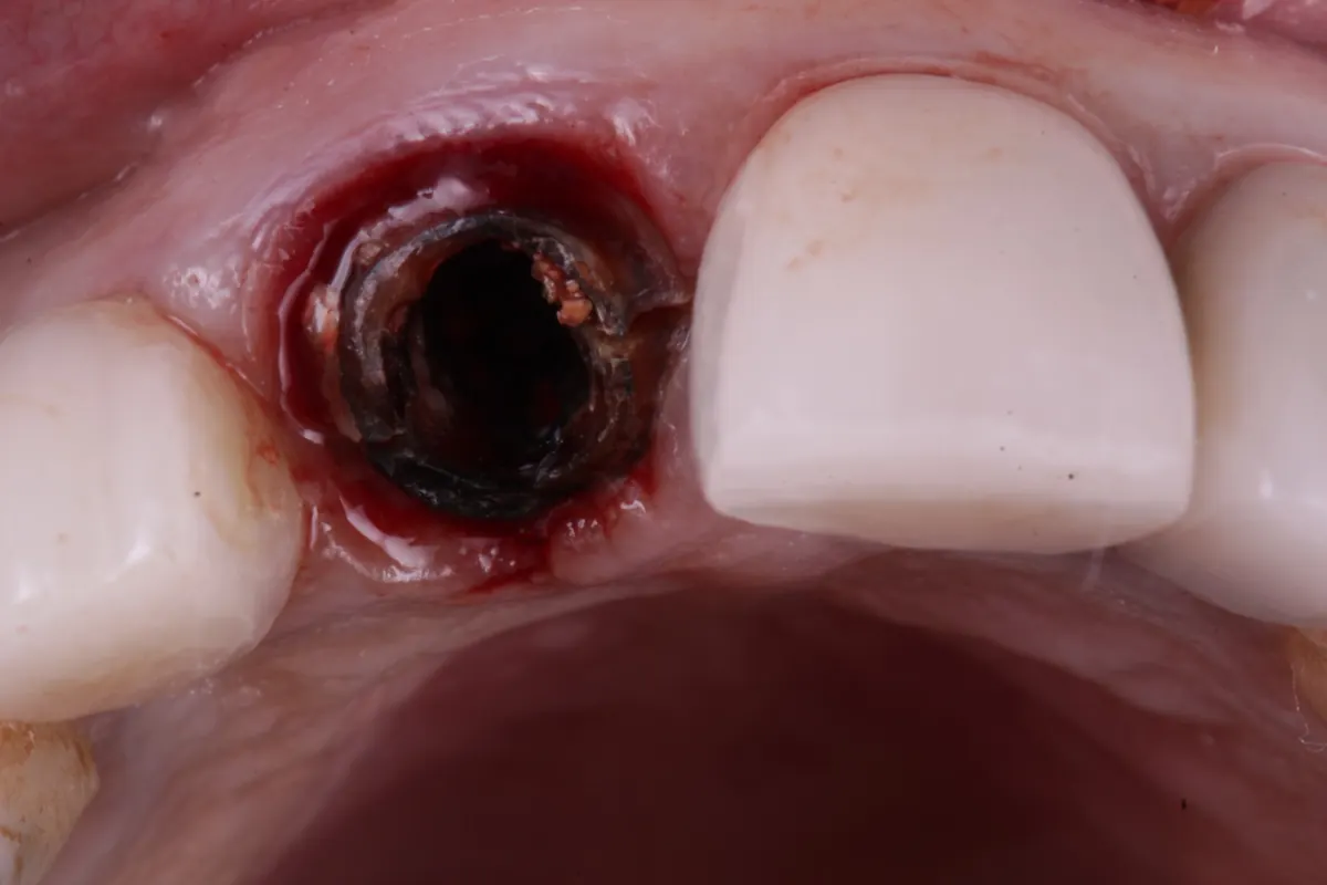 Antes do implante imediato, com a raiz do dente da frente comprometida
