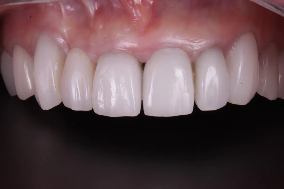 Depois: dente da frente reposto com implante imediato e coroa