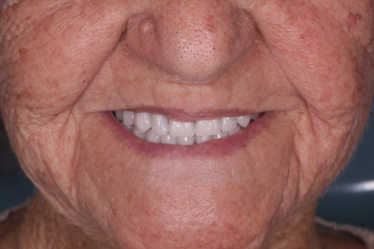 Depois: sorriso com prótese total nova