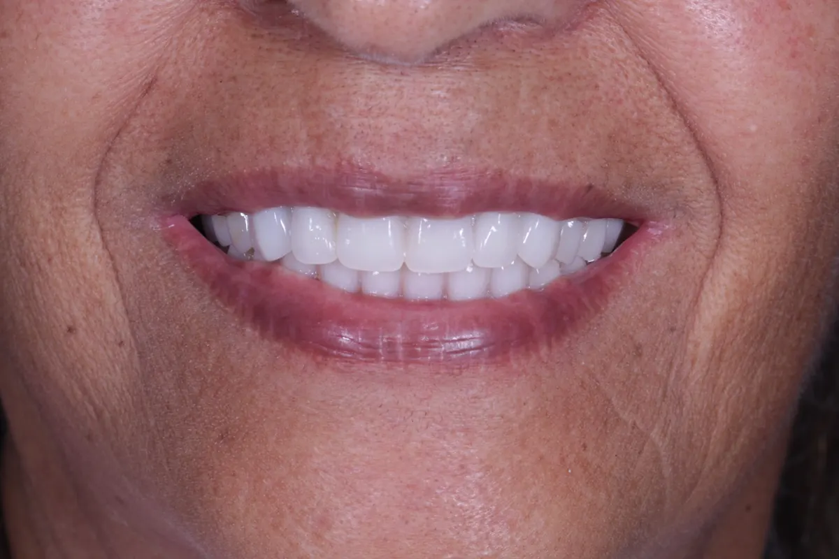 Depois: sorriso com prótese protocolo sobre implantes