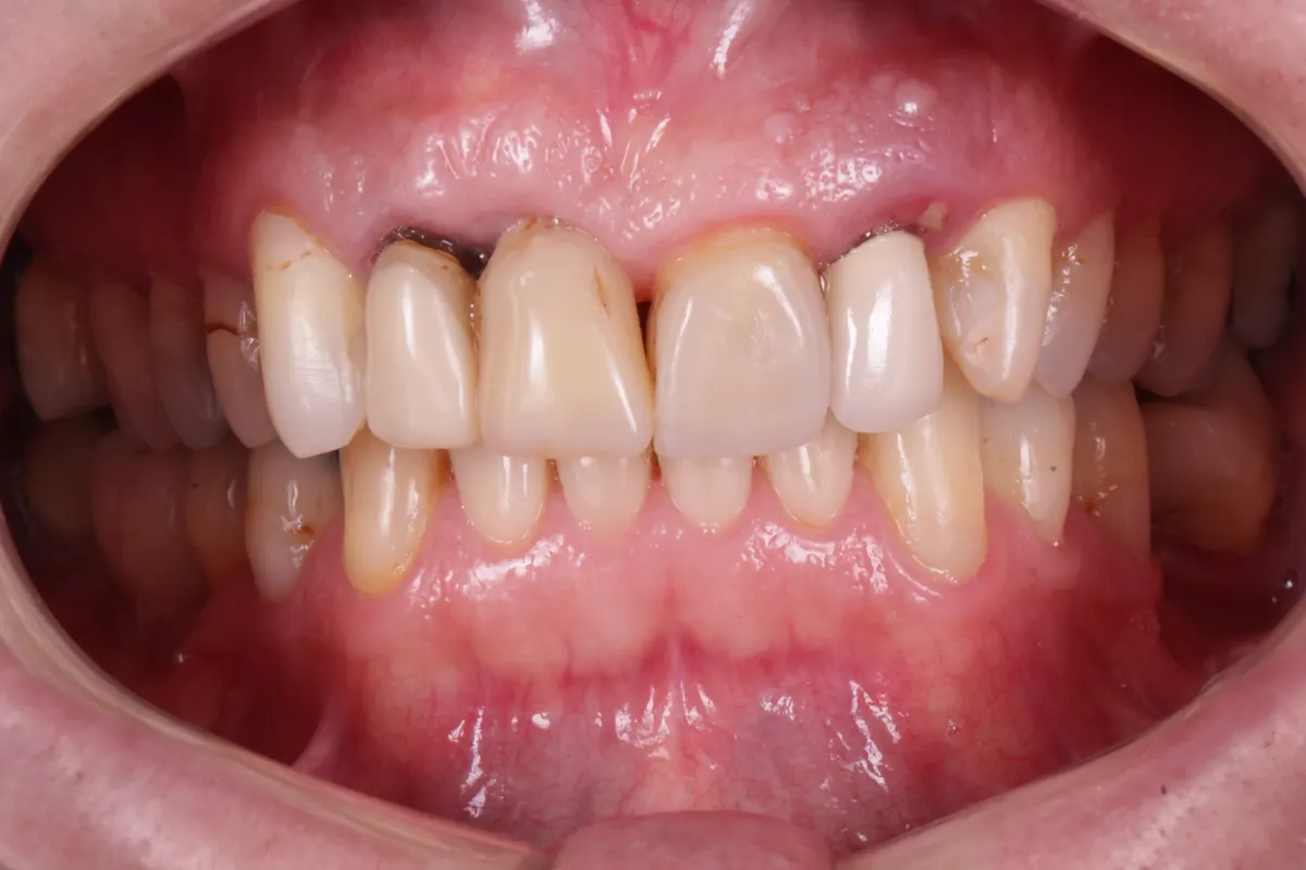 Antes da reabilitação oral estética