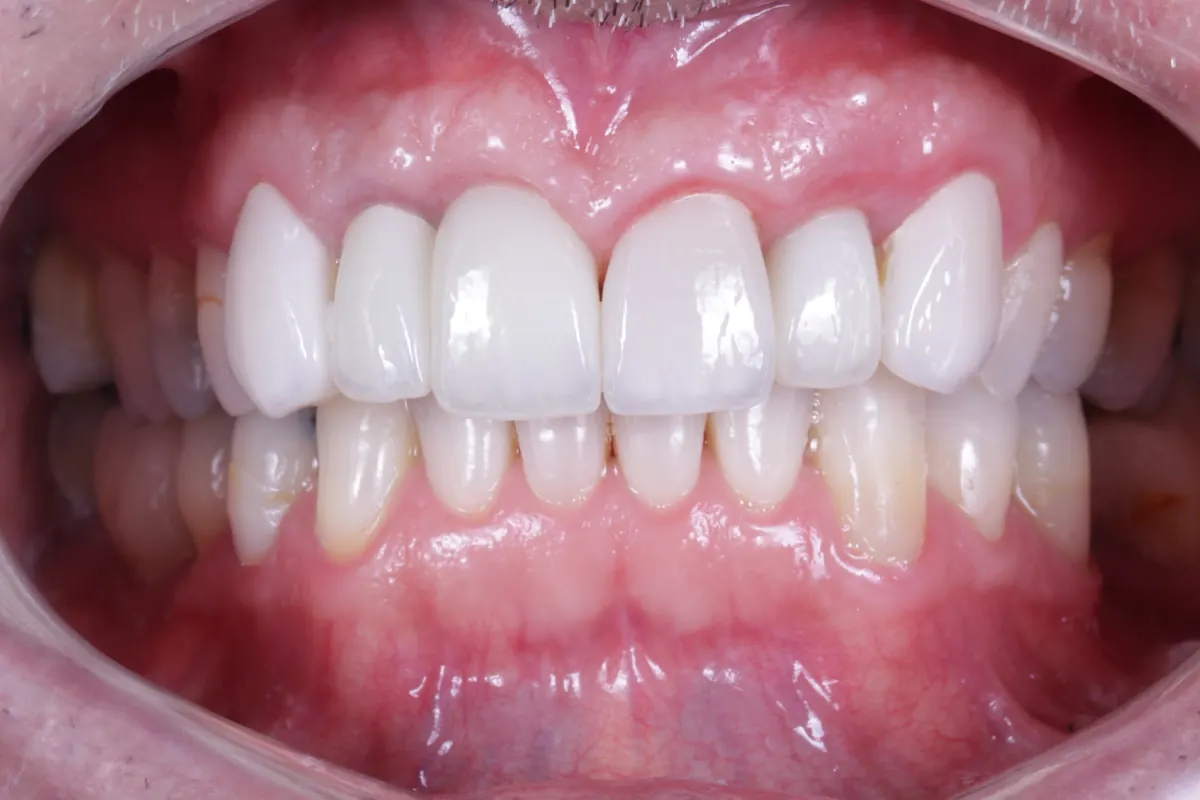 Depois: sorriso após reabilitação oral estética