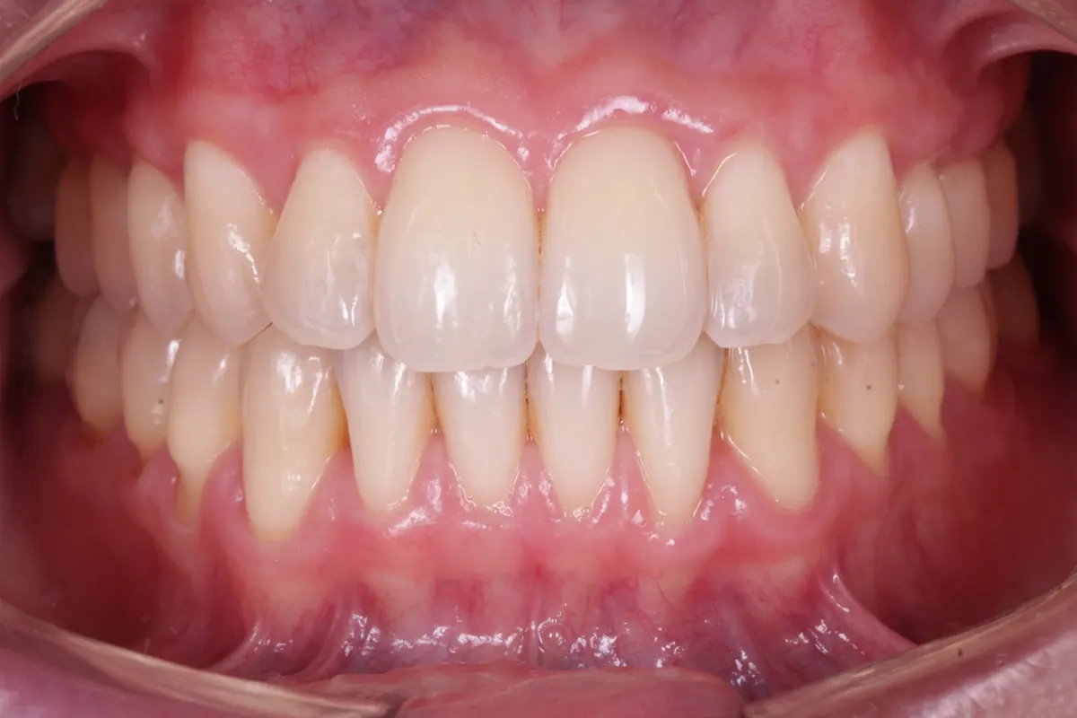 Antes do recobrimento radicular, com raiz do dente exposta